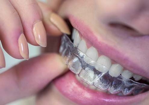 ortodoncia invisible ventajas