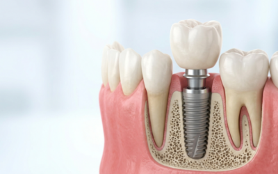 ¿Qué es la implantología y cómo funciona en el campo de la odontología?