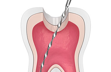¿Qué es lo que te hacen en una endodoncia?