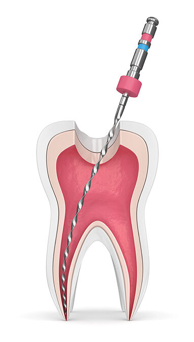 ¿Qué es lo que te hacen en una endodoncia?