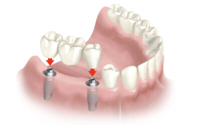 Implantología Dental: Rehabilitación Integral