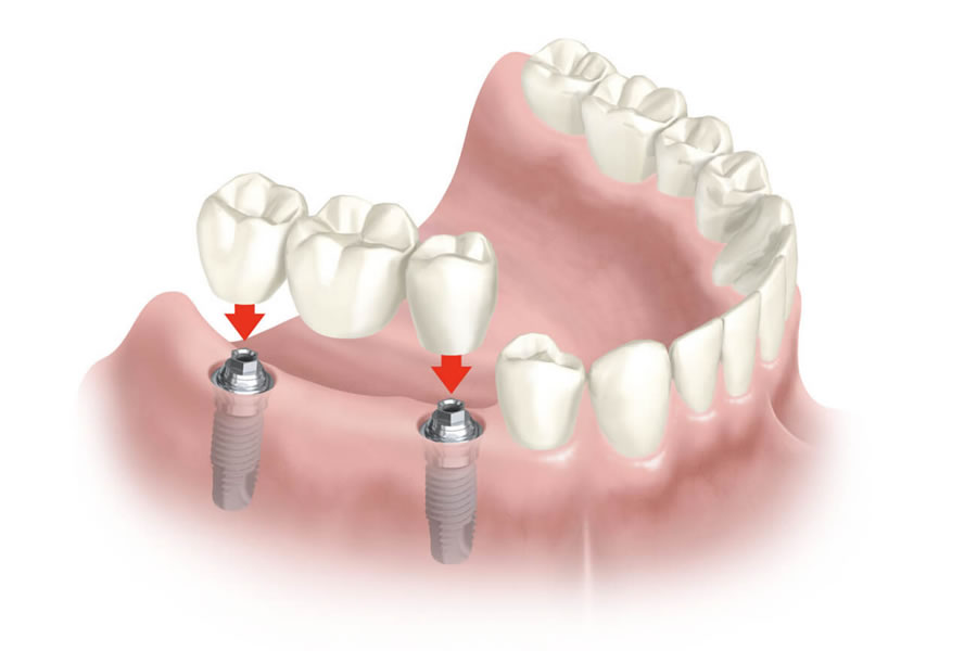 Implantología Dental: Rehabilitación Integral