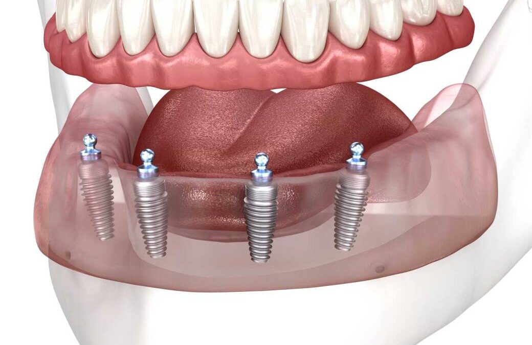 ¿Duele una endodoncia? Todo lo que necesitas saber antes del tratamiento
