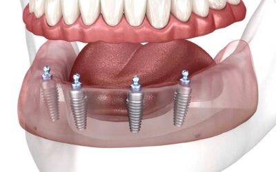¿Duele una endodoncia? Todo lo que necesitas saber antes del tratamiento